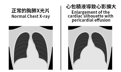 Pericardial Effusion